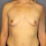 Breast Augmentation Before & After Patient #5222