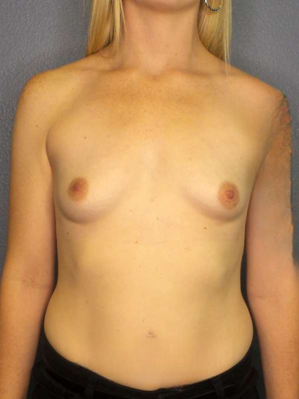 Breast Augmentation Before & After Patient #5222