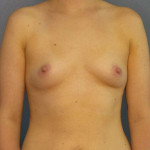 Breast Augmentation Before & After Patient #4952