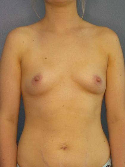 Breast Augmentation Before & After Patient #4952