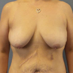Breast Lift with Implant (Augmentation Mastopexy) Before & After Patient #4601