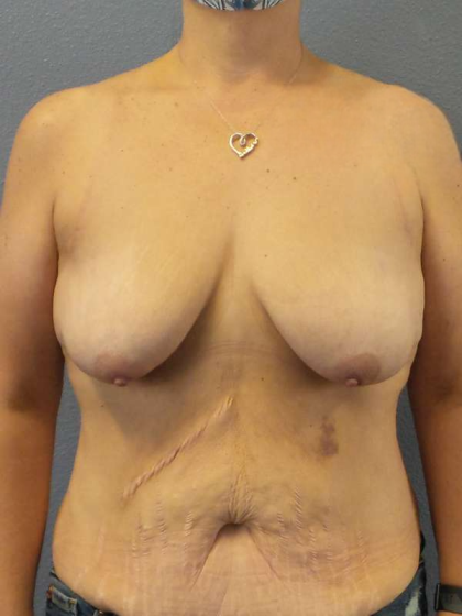 Breast Lift with Implant (Augmentation Mastopexy) Before & After Patient #4601
