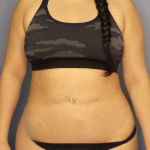 Liposuction Female Before & After Patient #8035