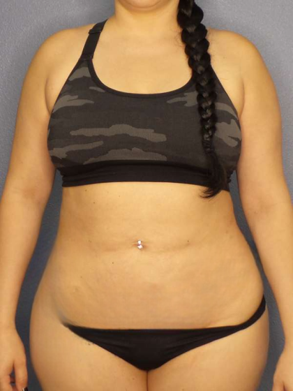 Liposuction Female Before & After Patient #8035