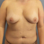Breast Lift with Implant (Augmentation Mastopexy) Before & After Patient #4509