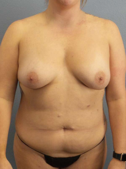 Breast Lift with Implant (Augmentation Mastopexy) Before & After Patient #4509
