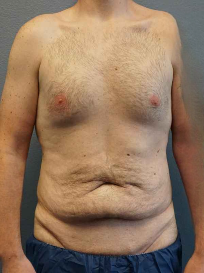 Male Liposuction Before & After Patient #3808