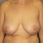 Breast Lift with Implant (Augmentation Mastopexy) Before & After Patient #4178