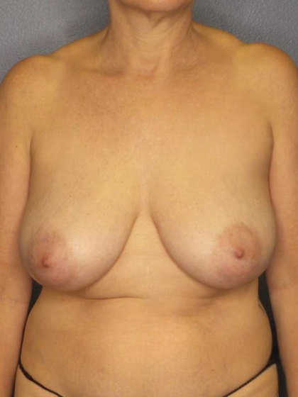 Breast Lift with Implant (Augmentation Mastopexy) Before & After Patient #4178
