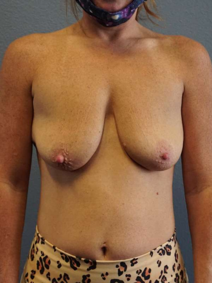 Breast Lift with Implant (Augmentation Mastopexy) Before & After Patient #4114