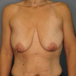 Breast Lift with Implant (Augmentation Mastopexy) Before & After Patient #3989