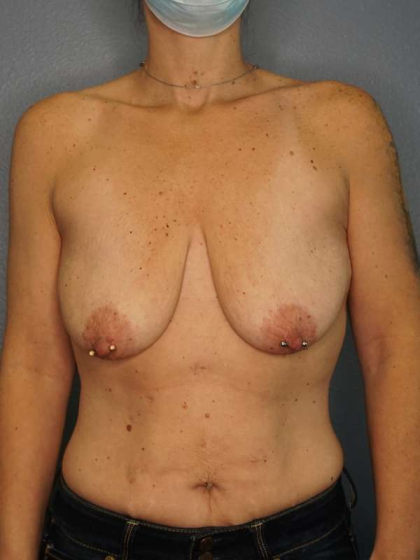 Breast Lift with Implant (Augmentation Mastopexy) Before & After Patient #3989