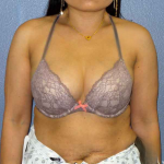Liposuction Female Before & After Patient #7951