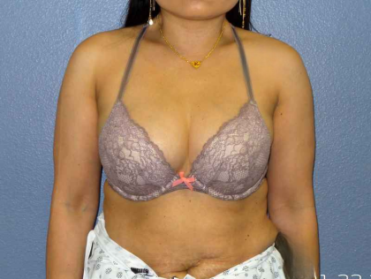 Liposuction Female Before & After Patient #7951