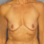Breast Augmentation Before & After Patient #7056