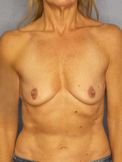 Breast Augmentation Before & After Patient #7056