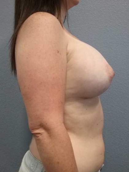 Breast Augmentation Before & After Patient #5729