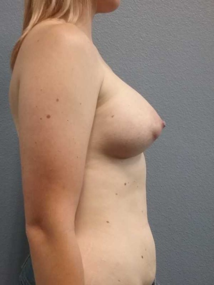 Breast Augmentation Before & After Patient #5706