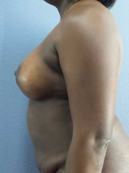 Breast Augmentation Before & After Patient #11436