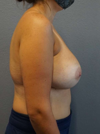 Breast Augmentation Revision (Breast Enlargement Repair) Before & After Patient #7302