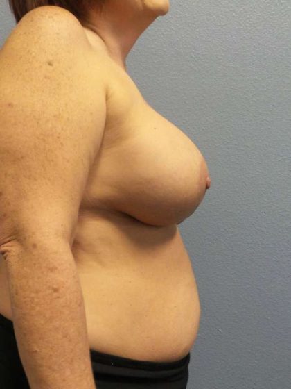 Breast Lift with Implant (Augmentation Mastopexy) Before & After Patient #4013