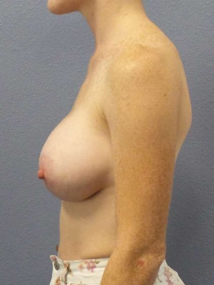 Asymmetric (Uneven) Breasts Before & After Patient #5914