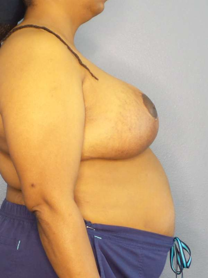 Mastopexy (Breast Lift) Before & After Patient #8402