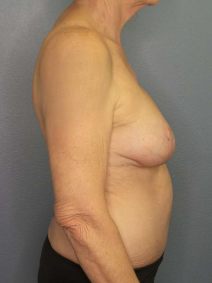 Mastopexy (Breast Lift) Before & After Patient #8377