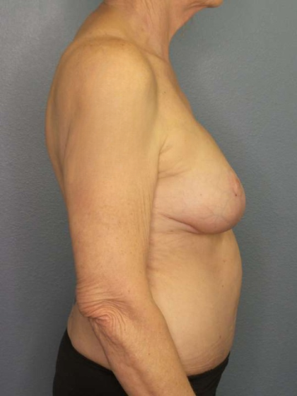 Breast Reduction Before & After Patient #7487