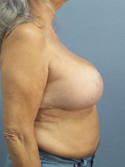 Breast Lift with Implant (Augmentation Mastopexy) Before & After Patient #3967