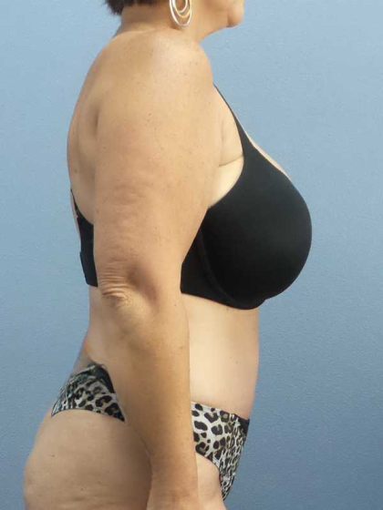 High BMI (Larger Patients) Surgery Before & After Patient #10438