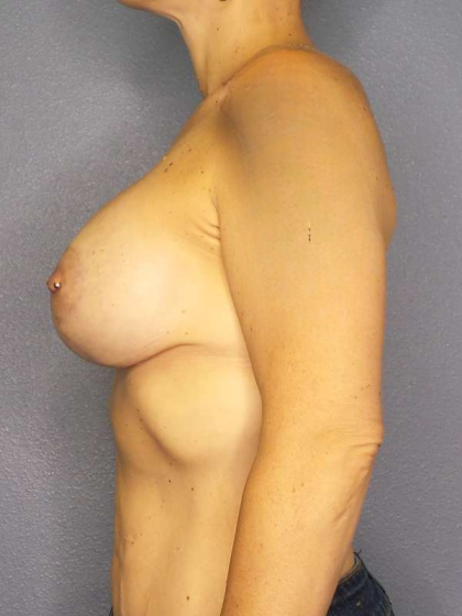 Breast Lift with Implant (Augmentation Mastopexy) Before & After Patient #3989