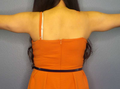 Liposuction Female Before & After Patient #7951