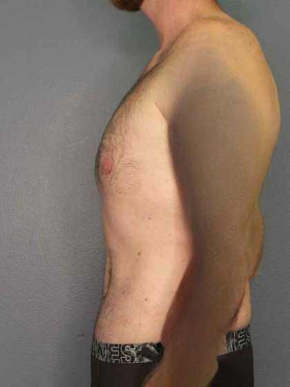 Male Liposuction Before & After Patient #3808