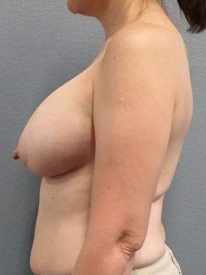 Breast Augmentation Before & After Patient #6749
