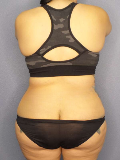 Liposuction Female Before & After Patient #8035