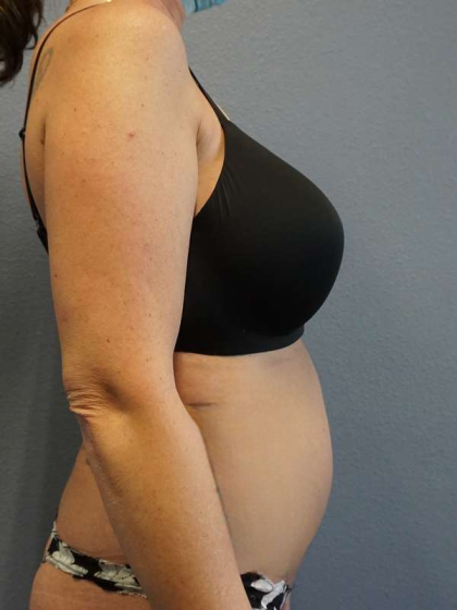 Liposuction Female Before & After Patient #8101
