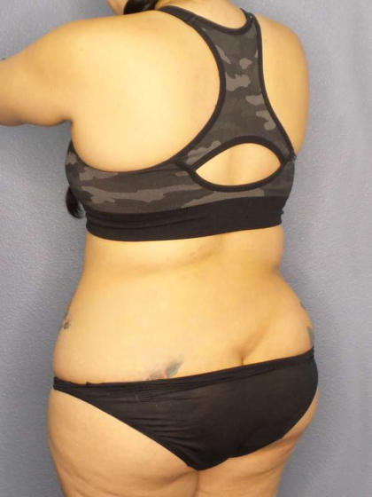 Liposuction Female Before & After Patient #8035