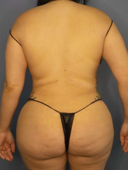 Liposuction Female Before & After Patient #8035