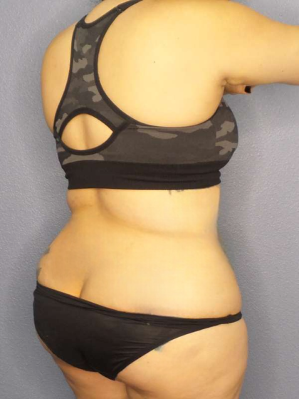 Liposuction Female Before & After Patient #8035
