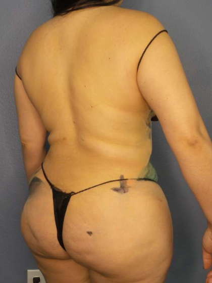 Liposuction Female Before & After Patient #8035