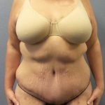 High BMI (Larger Patients) Surgery Before & After Patient #10393