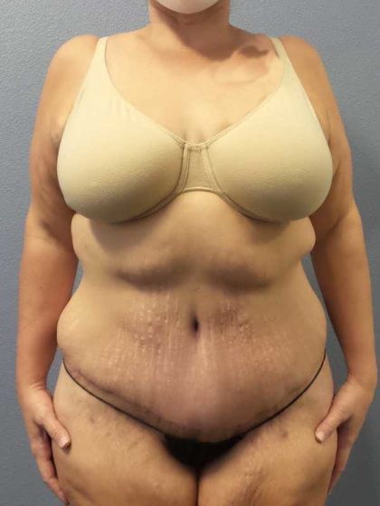 High BMI (Larger Patients) Surgery Before & After Patient #10393