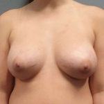 Breast Augmentation Before & After Patient #5607