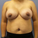 Breast Augmentation Before & After Patient #5114