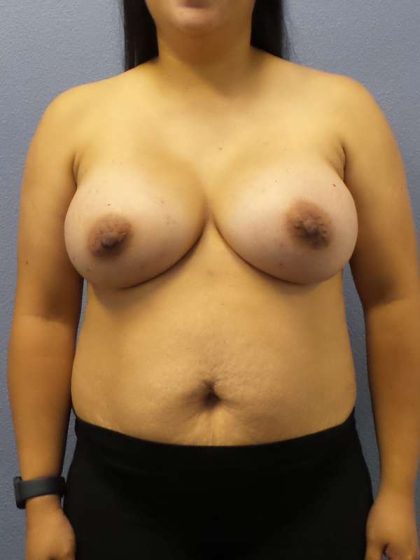 Breast Augmentation Before & After Patient #5114
