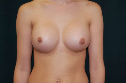 Breast Augmentation Before & After Patient #6578