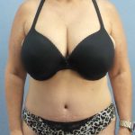 High BMI (Larger Patients) Surgery Before & After Patient #10438