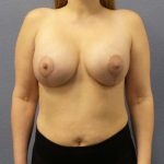 Breast Lift with Implant (Augmentation Mastopexy) Before & After Patient #4427