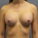 Breast Augmentation Before & After Patient #6457